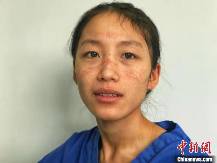 Vì đeo mặt nạ và kính bảo hộ trong thời gian dài, khuôn mặt Chen Ying đầy những vết hằn đỏ thẫm. Qua mỗi ngày, vết thương lại sâu thêm, vết cũ chưa kịp lành, cô đã tiếp tục mặc đồ để làm nhiệm vụ. Khi xem những bức ảnh của cô gửi, bạn trai Chen Ying đã trực tiếp đến bệnh viện vì lo lắng. Ảnh: Gương mặt Chen Ying trầy xước và đầy vết hằn do đồ bảo hộ.