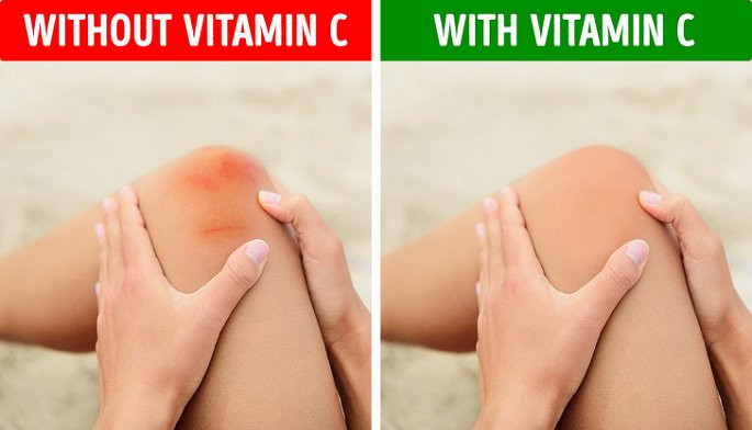 Dễ bầm tím, khó lành: Nếu bạn dễ bầm tím hơn những người khác và những vết bầm đó lại rất lâu lành thì đây là tình trạng cảnh báo cơ thể đang thiếu vitamin C. Lúc này, việc cần làm là bạn cần bổ sung thêm các loại trái cây, rau quả có múi. Bởi cơ thể đang rất cần vitamin C để sản xuất ra collagen, hỗ trợ chữa lành vết thương.