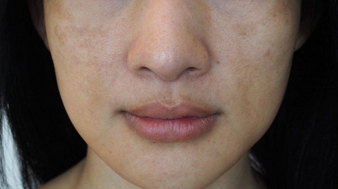 Da khô, xỉn màu: Vitamin C đặc biệt quan trọng để sản xuất collagen. Tuy nhiên, thiếu vitamin C khiến cơ thể không sản xuất đủ collagen. Chính nguyên nhân này khiến cho da của bạn khô, xỉn màu, nhăn nheo và thiếu sức sống hơn bình thường.