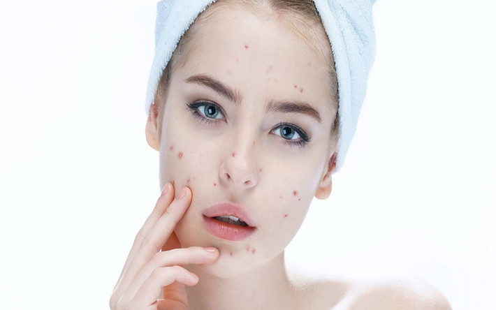 Sử dụng các sản phẩm chứa axit Salicylic để tiêu diệt các vi khuẩn gây mụn, kích thích da non phát triển. Hãy bôi một chút sản phẩm có axit Salicylic vào vùng da bị mụn trước khi đi ngủ, sau khi bạn đã rửa mặt thật sạch.