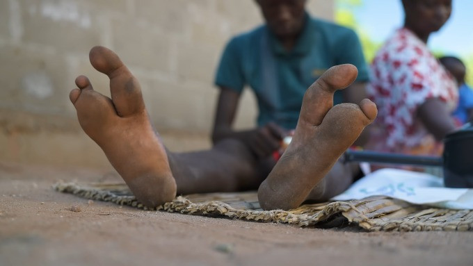  Bộ tộc Doma hay còn gọi Vadoma hay Bantwana sinh sống ở phía bắc Zimbabwe. Người dân bộ lạc này nổi tiếng khi mỗi bàn chân chỉ có 2 ngón. Ảnh: Drew Binsky.