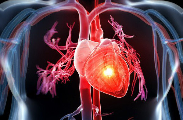  Bệnh ung thư khiến người ta nghe thấy đã hoảng sợ, nhưng đa số mọi người lại không biết rằng, còn có bệnh nguy hiểm và diễn tiến nhanh hơn ung thư nhiều, đó là bệnh suy tim. (Ảnh minh họa)