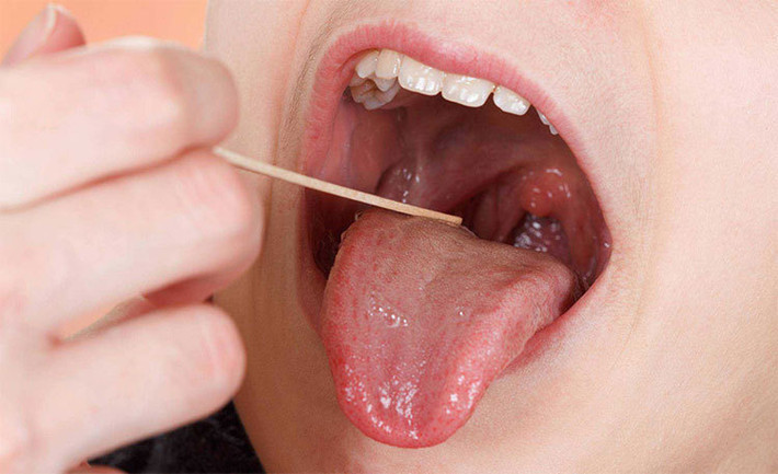 Loét miệng hay còn gọi là bệnh loét miệng là một bệnh lý răng miệng rất phổ biến, đặc biệt khi cơ thể bốc hỏa hoặc thiếu chất dinh dưỡng thì trên niêm mạc miệng sẽ xuất hiện một số vết loét hình tròn, kèm theo đó là những cơn đau nhức. Lúc này, chỉ cần bạn điều tiết hợp lý mọi mặt trong cuộc sống và bổ sung thêm nhiều nước thì hiện tượng này sẽ nhanh chóng thuyên giảm.