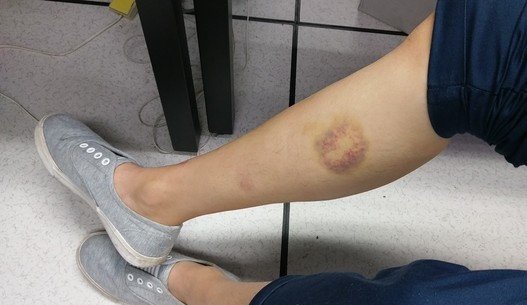 Sau khi tiếp tục khám xét và điều trị, bác sĩ phát hiện cả hai người đều ung thư gan, một người ung thư giai đoạn cuối và một người cũng đã ung thư giai đoạn giữa. Người ung thư gan giai đoạn cuối tử vong sau chưa đầy một tháng kể từ khi được phát hiện bệnh mặc dù đã tích cực hợp tác điều trị.