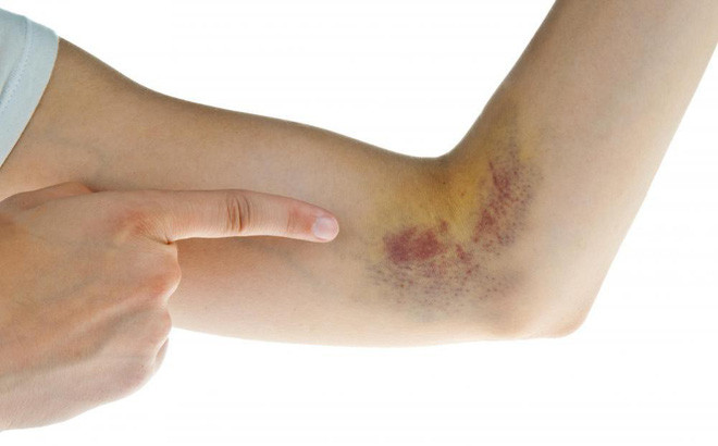 Thế nhưng sau khi kiểm tra máu, siêu âm và chụp cắt lớp vi tính, bác sĩ phát hiện cả hai bệnh nhân đã bị ung thư gan ở giai đoạn cuối và giai đoạn giữa. Đặc biệt, các khối u gan có dấu hiệu vỡ.