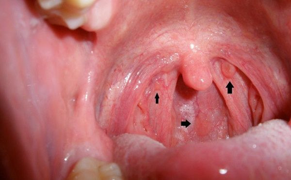 Thế nhưng, nếu triệu chứng lở loét miệng diễn ra thường xuyên thì chứng tỏ nó đã kháng lại nhiều loại thuốc và vi khuẩn có lợi, nếu không chú ý thì chúng ta có thể mắc bệnh ung thư miệng, cực kỳ nguy hiểm.