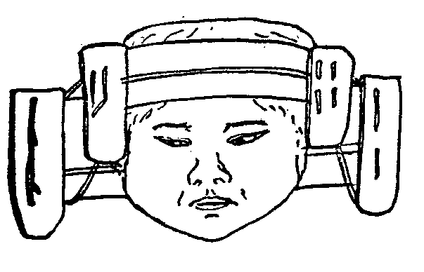 Sau một khoảng thời gian, người Maya hoàn thành quá trình làm thay đổi hình dáng hộp sọ của đứa trẻ.
