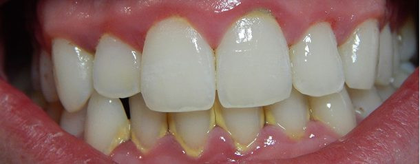 Ngăn chặn sự tích tụ cao răng: Bạn nên đánh răng ngày 2 lần để kiểm soát cao răng hoặc sử dụng nước súc miệng để loại đi các mảng bám tạo nên cao răng.