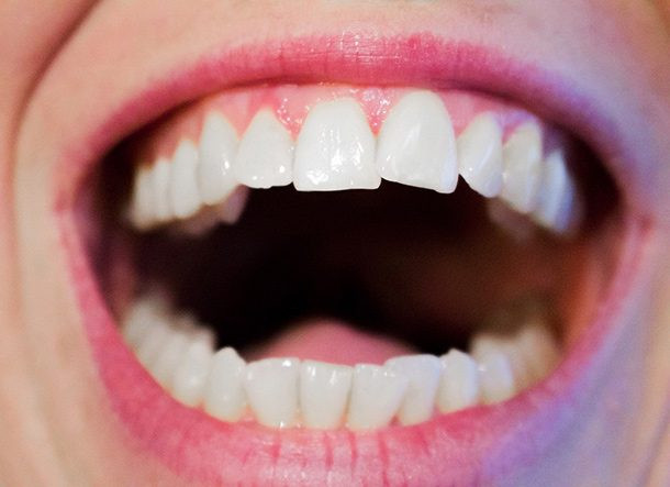 Ngăn ngừa sâu răng: Đánh răng vào buổi tối không chỉ ngăn ngừa sự tích tụ của vi khuẩn, mà còn làm giảm nguy cơ sâu răng do sự hình thành các mảng bám.