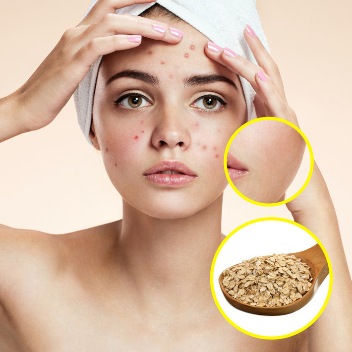 Bột yến mạch giúp làm sạch và giữ ẩm cho bệnh nhân bị viêm da, dị ứng, da khô và bệnh rosacea. Thêm một số yến mạch vào nước ấm trong bồn tắm để làm dịu da bị kích thích.