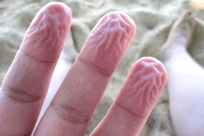 Da nhăn nheo: Bạn có thể nhận thấy rằng sau khi tắm hoặc bơi, ngón tay và ngón chân trở nên nhăn nheo.