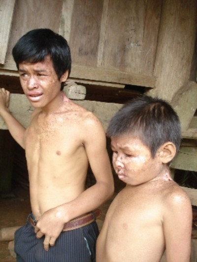 Trước đó, tại Việt Nam cũng ghi nhận nhiều ca bệnh lạ y học phải bó tay như căn bệnh lạ bùng phát khiến nhiều đứa trẻ ở xã Mường Chiềng, huyện Đà Bắc, tỉnh Hòa Bình bị ngứa ngáy và lở loét, bong tróc da toàn thân. Có những em bị nặng còn biến dạng cả khuôn mặt, tinh thần và trí tuệ kém phát triển.