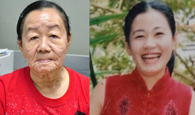 Thiếu nữ bỗng dưng biến thành bà già: Sinh năm 1985, quê ở Bến Tre, Nguyễn Thị Phượng lớn lên hoàn toàn như bao cô gái khác. Năm 2007, Phượng thấy ngứa da mặt và tay nên mua thuốc chống dị ứng về uống nhưng không khỏi. Hai tháng sau, gương mặt và hai cánh tay bỗng ngày càng đỏ, nổi mẩn. Từ đó da mặt cô chảy xệ và nhăn nheo trông thấy, nhìn y hệt một “bà cụ 70 tuổi”. Theo kết luận của các chuyên gia da liễu, chị Phượng bị bệnh tế bào vón, nhão da. Theo các tài liệu chuyên khoa da liễu, tỷ lệ mắc bệnh tế bào vón khoảng 1/160.000. Riêng trường hợp nhão da phối hợp cùng tế bào vón như chị Phượng là rất hiếm. Đến năm 2015, chị Phượng qua đời do mắc chứng đau dạ dày. Video: Bé gái mắc hội chứng “mọc cây trên người”. Nguồn: VTC