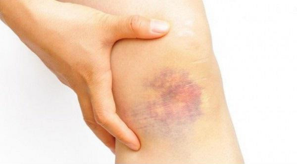 Nếu vết bầm xuất hiện không rõ lý do cũng như chẳng hề có cảm giác đau đớn, bạn đừng nên chủ quan vì đó có thể là dấu hiệu của một một số bệnh nguy hiểm.