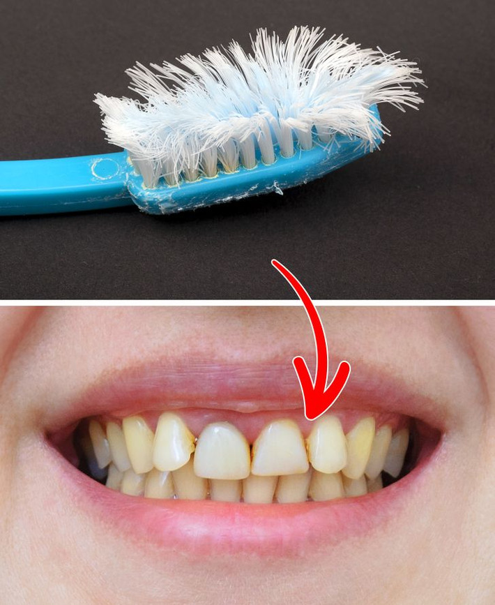 Dùng bàn chải lông cứng: Sử dụng bàn chải cứng sẽ không làm cho răng trắng thêm mà trên thực tế, chải quá mạnh có thể làm mòn men răng. Điều này sẽ khiến răng dễ bị sâu và dễ bị ố vàng. Các nha sĩ khuyên bạn nên sử dụng bàn chải đánh răng mềm và thay mới sau mỗi 3 tháng.