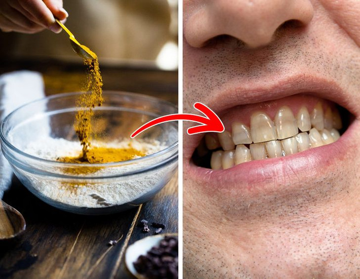 Ăn nhiều gia vị: Nêm gia vị vào thức ăn sẽ tăng thêm hương vị và nhiều mùi thơm khác nhau cho món ăn nhưng cũng có thể khiến răng bị ố vàng. Một số loại gia vị có sắc tố cao như cà ri có thể làm răng ngả sang màu hơi vàng. Nếu muốn thêm hương vị cho các món ăn, hãy thử dùng các loại thảo mộc như nghệ, cỏ xạ hương, quế... để bảo vệ sức khoẻ răng miệng.