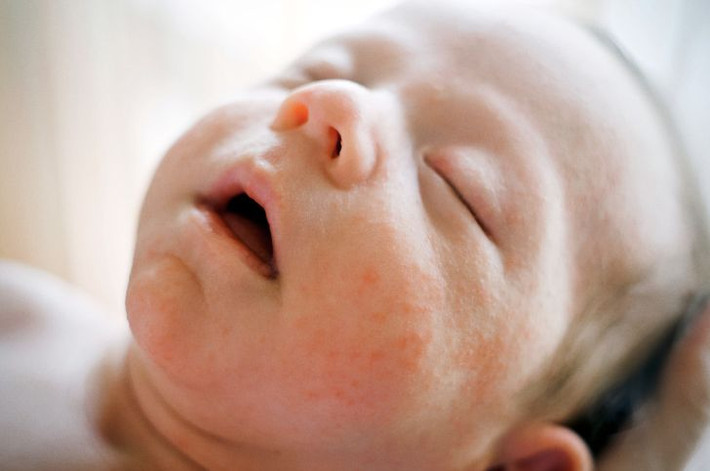 Bé có thể bị nổi mụn. Các hormone mà em bé nhận được từ mẹ sẽ kích thích các tuyến dầu mọc mụn trên da. Vì các lỗ chân lông trên da trẻ sơ sinh chưa phát triển hoàn thiện nên chúng trở thành mục tiêu dễ dàng cho bụi bẩn len lỏi vào.
