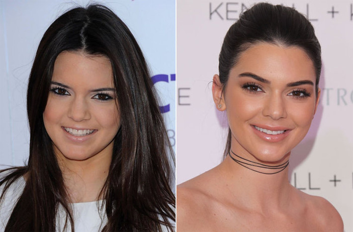 Chỉ cần so hình ảnh Kendall Jenner năm 2010 (trái) và năm 2016 sẽ thấy rõ ràng mũi và môi của cô có sự khác biệt rõ. Tuy nhiên ngôi sao truyền hình thực tế kiêm người mẫu này vừa lên tiếng phủ nhận và cho rằng đó là tin đồn điên rồ. (Ảnh: Daily Hairdo)