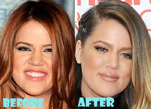 Mặc dù Khloe Kardashian phủ nhận nghi vấn nâng mũi, nhưng nhìn ảnh trước và sau của cô thì không còn ai nghi ngờ gì nữa. (Ảnh: plasticsurgerygal)