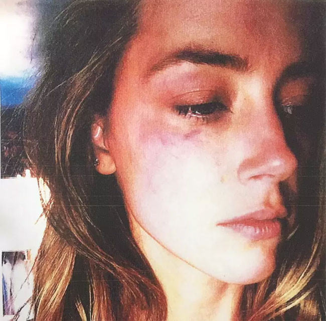 Ngày 21/5/2016, Amber Heard bị Johnny Depp đánh khi anh đang say rượu. Ngay lập tức nữ diễn viên 30 tuổi đã đệ đơn ly hôn chồng và xin tòa lệnh yêu cầu Depp tránh xa mình. Trong đơn ly hôn, Amber cho biết Depp thường xuyên say xỉn và đánh đập cô trong suốt thời gian 15 tháng hôn nhân. (Ảnh: nydailynews)