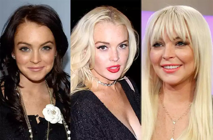 Theo bác sĩ thẩm mỹ Garth Fisher, khuôn mặt nặng chịch của Lindsay Lohan hiện tại là do nhiều lần cô tiêm chất làm đầy.
