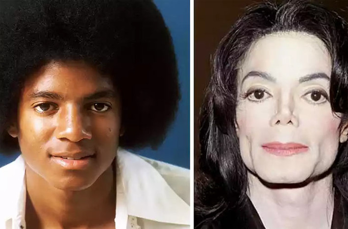 Michael Jackson đã dành hẳn 30 năm cuộc đời để phẫu thuật thẩm mỹ hơn 100 lần các kiểu với mục đích biến đổi từ làn da màu sang da trắng và biến đổi hoàn toàn các nét trên khuôn mặt mình.