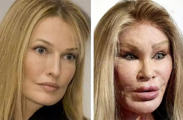Jocelyn Wildenstein trở nên nổi tiếng bởi rất nghiện phẫu thuật thẩm mỹ. Bà đã dành hẳn 4 triệu USD để dao kéo khuôn mặt với mục đích biến khuôn mặt mình thành một con mèo rừng vì chồng thích loài thú đó. Thế nhưng mọi nỗ lực của bà cũng không thể giữ chân chồng và hai người ly hôn vào năm 1999.