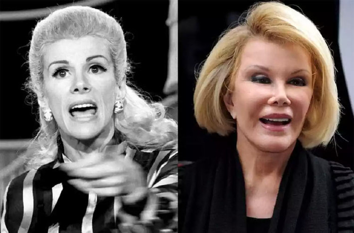Cố diễn viên Joan Rivers trải qua không biết bao nhiêu cuộc phẫu thuật thẩm mỹ nào nâng mí, nâng mũi, độn ngực. Bà thừa nhận những lần phẫu thuật thẩm mỹ đó và không hề thấy hối tiếc. Theo con gái của Joan, bà đã trải qua tới 348 cuộc dao kéo và chưa lúc nào cảm thấy hài lòng với ngoại hình của mình.