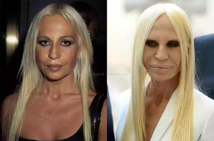 Nhà thiết kế nổi tiếng của thương hiệu Varsace, Donatella Versace, là một trong những ngôi sao nhận hậu quả nặng nề của phẫu thuật thẩm mỹ quá đà.