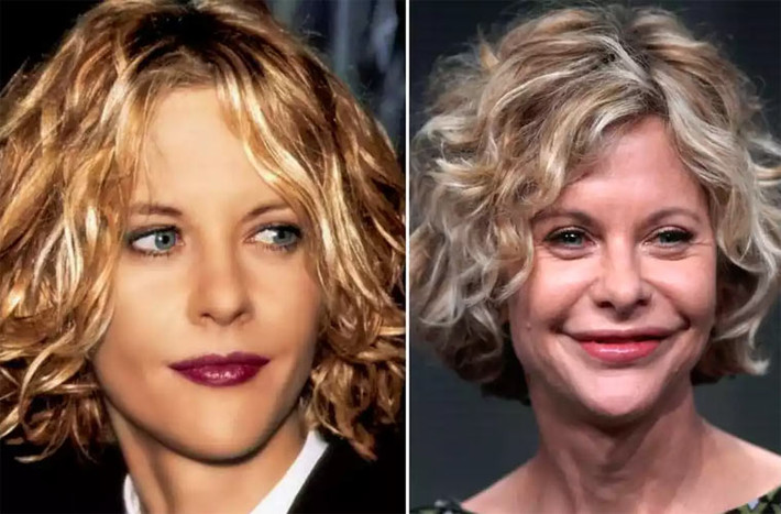 Khuôn mặt thon gọn, tươi tắn và sinh động của Meg Ryan ngày nào giờ cứng đơ và vô hồn bởi nhiều lần tiêm Botox. Có tin ngôi sao "Không ngủ ở Seattle" còn phẫu thuật kéo căng da cổ và trán.