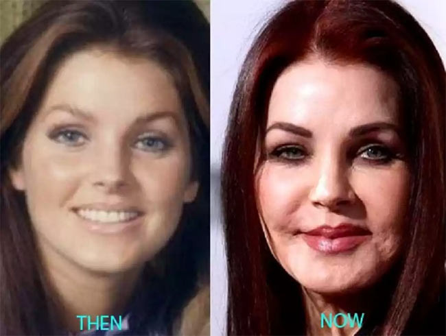 Priscilla Presley, vợ cũ của ông vua Rock and Roll Elvis Presley, đã thay đổi khuôn mặt hoàn toàn kể từ khi phẫu thuật thẩm mỹ từ cấy má, tiêm Botox, nâng cơ mặt. Dao kéo quá đà khiến nhiều người nhận xét khuôn mặt Priscilla cứng đờ và mọi biểu hiện trên khuôn mặt lúc nào cũng giống nhau.