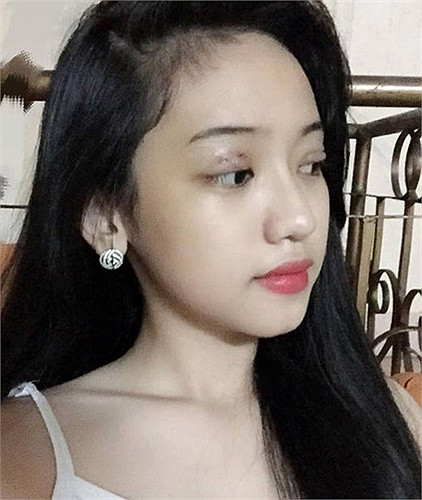 Tuy vẫn còn ngồi trên ghế nhà trường, Thúy Vi không ngần ngại công khai chuyện phẫu thuật thẩm mỹ. Để có được nhan sắc như hiện tại, cô nàng đã thực hiện cắt mí mắt và sửa mũi. Việt hot girl Thúy Vi công khai chuyện phẫu thuật thẩm mỹ trong khi còn ngồi trên ghế nhà trường khiến nhiều người bất ngờ.