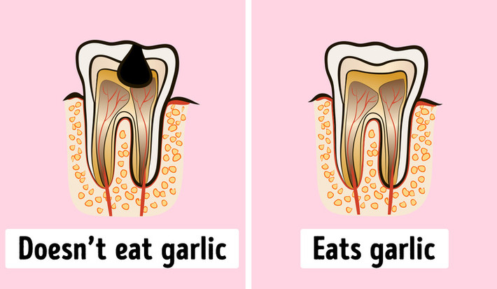 Giảm đau răng: Nhờ các thành phần kháng khuẩn và chống nấm, tỏi có lợi cho khoang miệng. Nó giúp tiêu diệt các vi khuẩn và điều trị viêm lợi. Thêm vào đó, tỏi giúp giảm nguy cơ sâu răng.