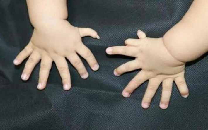 Chứng đa ngón: Người bị chứng đa ngón có nhiều hơn 10 ngón tay hoặc ngón chân, trong đó ngón thừa thường không có xương, chỉ có phần mềm (da, cơ, tổ chức liên kết).