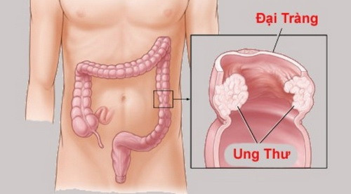 Chúng ta phải chăm sóc đại tràng bằng cách ăn nhiều chất xơ từ rau, trái cây, các loại hạt, ngũ cốc, và giảm tiêu thụ thịt đỏ, thực phẩm chiên, đường, rượu và cà phê. Nó cũng tốt để bỏ hút thuốc và bắt đầu uống đủ nước mỗi ngày. Hãy chú ý đến các triệu chứng ở trên và đừng ngần ngại gặp bác sĩ, nếu cần thiết. Ảnh: BS.