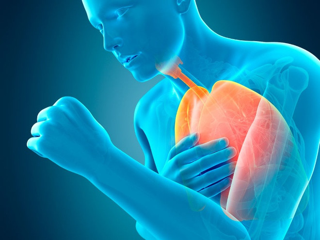 Bệnh phổi tắc nghẽn mạn tính (COPD): Nguyên nhân chính gây bệnh phổi tắc nghẽn mạn tính là tiếp xúc lâu với các chất gây ô nhiễm không khí. Ô nhiễm không khí cũng là tác nhân làm trầm trọng bệnh COPD. Khi tiếp xúc các hạt ô nhiễm, bệnh nhân mắc COPD dễ bị phát bệnh, cấp cứu, thậm chí có nhiều trường hợp tử vong trong hoàn cảnh khắc nghiệt. Ở các nước kém phát triển, COPD chủ yếu xảy ra do sử dụng than để nấu ăn, sưởi ấm... Ảnh: Mayoclinic.