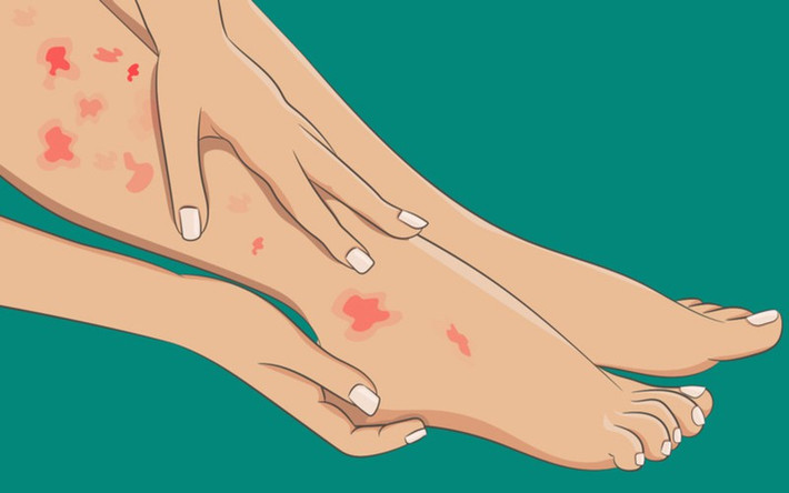 Nổi mẩn đỏ ở chân: Nếu chân bạn nổi những đốm màu đỏ tươi, đỏ sẫm hoặc tím và có thể đi kèm với một số phản ứng như ngứa, dát trong thời gian dài, thì đây cũng có thể là dấu hiệu cảnh báo bệnh viêm mạch máu, và một số bệnh tự miễn dịch như lupus hoặc viêm khớp dạng thấp.