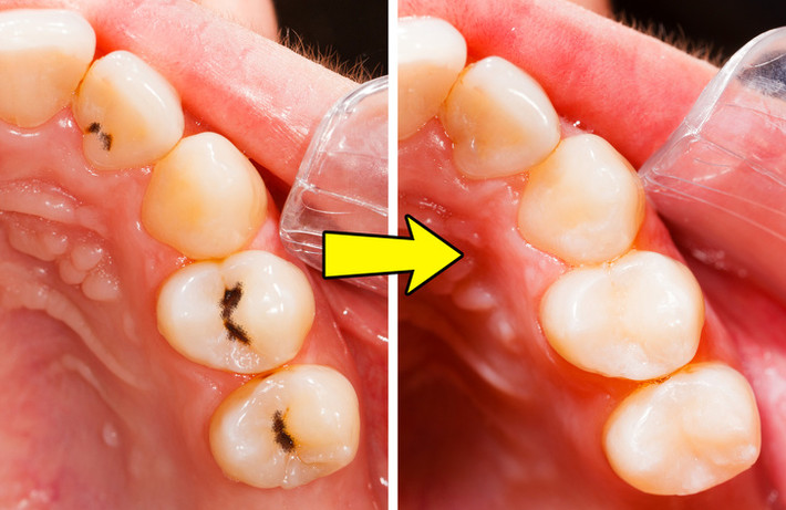 Răng chắc khỏe hơn: Hạt điều có chứa axit anacardic, chất giúp tiêu diệt vi khuẩn răng miệng, ngăn ngừa sâu răng hiệu quả.