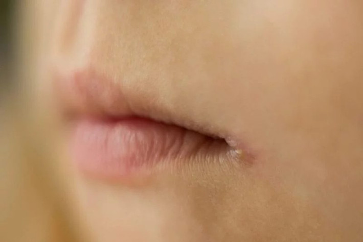Viêm môi vùng mép: Viêm môi vùng mép thường bắt đầu từ vết nứt nẻ ở mép nhưng rồi có thể lan ra khắp môi nếu không được chữa trị. Có nhiều nguyên nhân gây viêm môi, như thiếu vitamin hoặc do liếm môi quá nhiều.