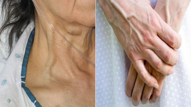 Gân xanh ở lồng ngực hoặc vùng bụng: Đây là biểu hiện của bệnh xơ gan hay một khối u trong cơ thể. Do đó, khi gặp phải trường hợp này thì bạn cần đi khám để biết rõ hơn về tình trạng sức khỏe hiện tại.