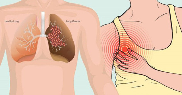 Thường xuyên bị nhiễm trùng: Ung thư phổi có thể gây ra tình trạng nhiễm trùng ảnh hưởng đến đường hô hấp và dẫn đến các bệnh như viêm phế quản hoặc các bệnh nhiễm trùng mãn tính khác. Nếu bạn bị nhiễm trùng phổi mãn tính, bạn nên đi chụp X-Quang phổi để biết mình có nguy cơ bị ung thư phổi hay không.