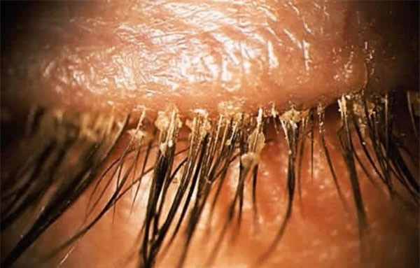 Tại bệnh viện Haida, Sơn Đông các bác sĩ đã trực tiếp gắp khoảng 20 con rận mu ra khỏi lớp mủ trắng dưới mắt bà Zhang.