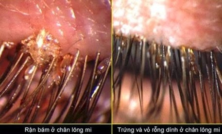 Cuối cùng các bác sĩ đã khám và bắt rất nhiều con rận mu bám và ký dinh trên mắt cháu bé.