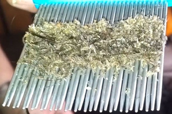 Kẽ chiếc lược chải tóc cho cô gái bị rận ký sinh "đặc kịt" bởi hàng trăm con chấy rận và tổ ấu trùng.