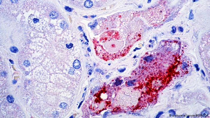 Người nhiễm virus Nipah thường có các triệu chứng như: sốt và đau đầu trong khoảng từ 3 ngày đến 2 tuần. Sau đó, bệnh nhân có thể bị ho, đau họng và gặp các vấn đề về hô hấp.