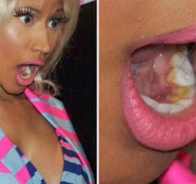Nicky Minaj bị chê là răng miệng kém vệ sinh khi nữ rapper để lộ ra hàm răng đầy cao vàng khè.