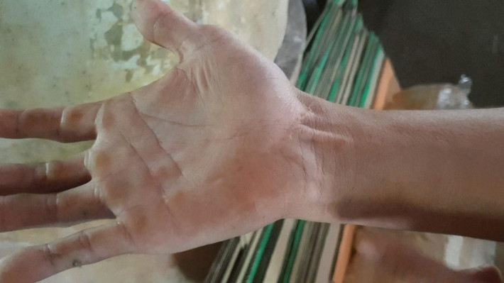Theo lời kể của anh Nguyễn Tiến Dũng, con khỉ đực được gia đình nuôi khoảng 8 năm nay. Cách đây 3 năm, anh bị nó cắn do bất cẩn cho lúc cho ăn. Vì vậy, anh phải khâu hơn 10 mũi và sau 1 tháng mới bình phục.