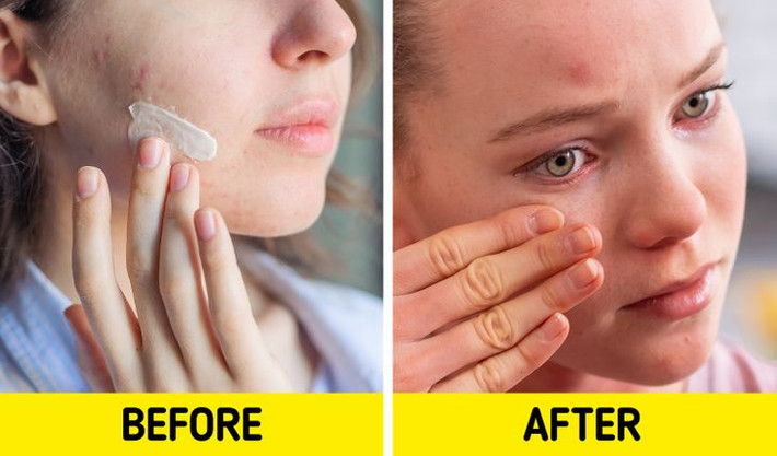 Sản phẩm trị mụn: Một số sản phẩm trị mụn có thể khiến da khô và kích ứng. Mặc dù đây chỉ là triệu chứng tạm thời nhưng da vẫn có thể bị ngứa, bong tróc hay thậm chí là bỏng.