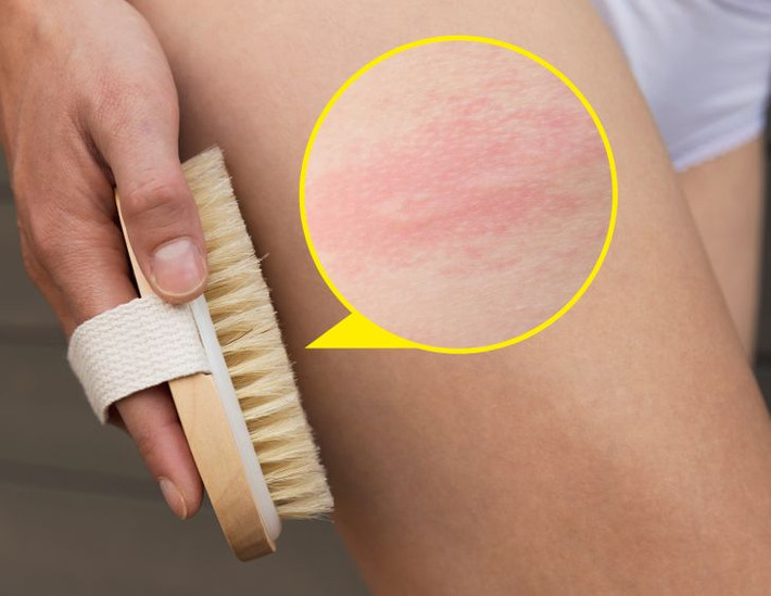 Bàn chải khô: Sản phẩm làm đẹp thông dụng này giúp tẩy tế bào chết hiệu quả nhưng không phải ai cũng thích hợp dùng. Những người có làn da khô hoặc da mẫn cảm có thể bị kích ứng, khiến da khô quá mức. Những người bị viêm da, chàm hay bệnh vẩy nên không nên dùng bàn chải khô vì nó có thể gây nhiễm trùng.