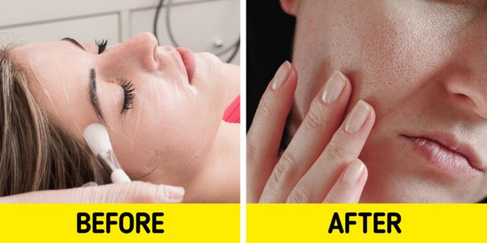 Tẩy da chết hoá học: Nếu bạn đang sử dụng sản phẩm tẩy da chết hoá học nhiều hơn một lần mỗi tuần thì nên kiểm tra lại tình trạng da. Lạm dụng sản phẩm này có thể làm hỏng lớp màng bảo vệ tự nhiên của da, dễ gây viêm, nổi mụn hay khiến da mẩn đỏ, kích ứng.
